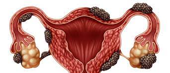 Benefícios pouco conhecidos da Cirurgia Robótica de Endometriose